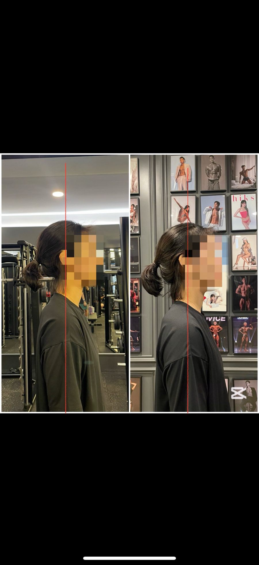 거북목 두통 자세 교정 비포애프터